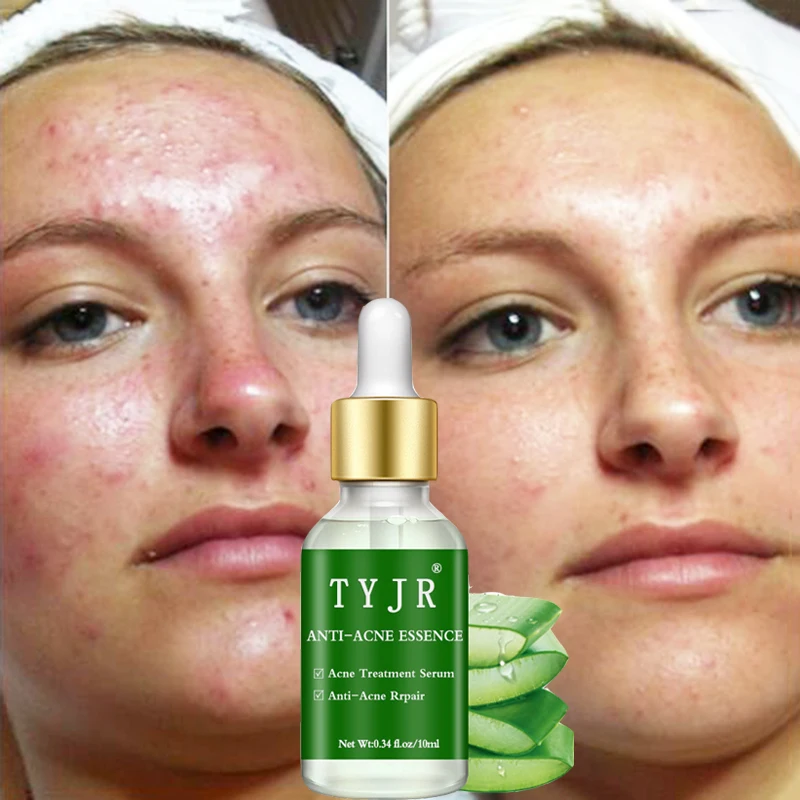 

Make up Base Aloe Acne Essence Skin Moisturizing Oil Controlling Facial Serum to Blackhead Acne Shrink Pores Repairing 10ml