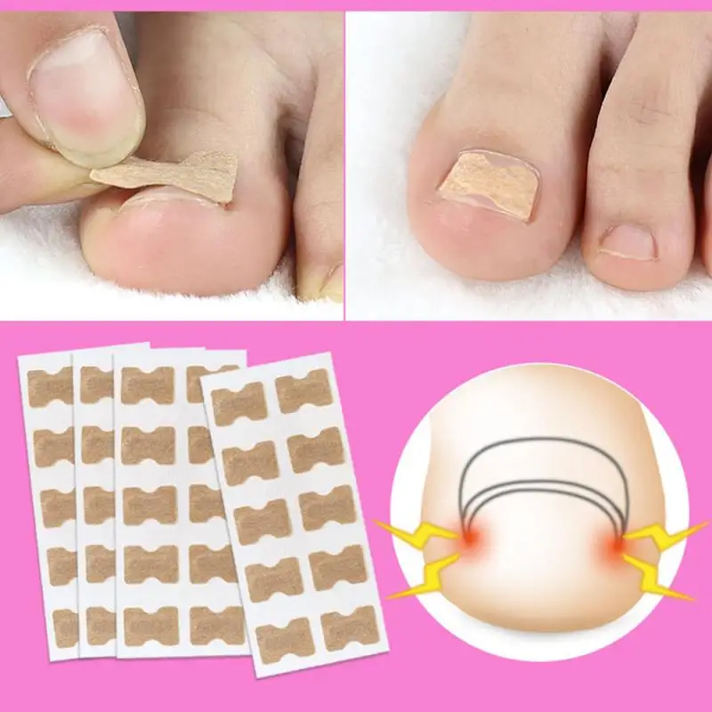 

1/5Pcs Nail Strips Anti-roll Nail Free Glue Toe Inlay Nail Corrector Nail Patch Correction Stickers Toenails Nail Care Foot care