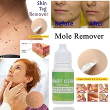 10 мл лечение бородавок удаление омертвевшей кожи очищающий прибор для удаления родинок для ног удаление кукурузы удаление кожи тег для ухода за кожей ног