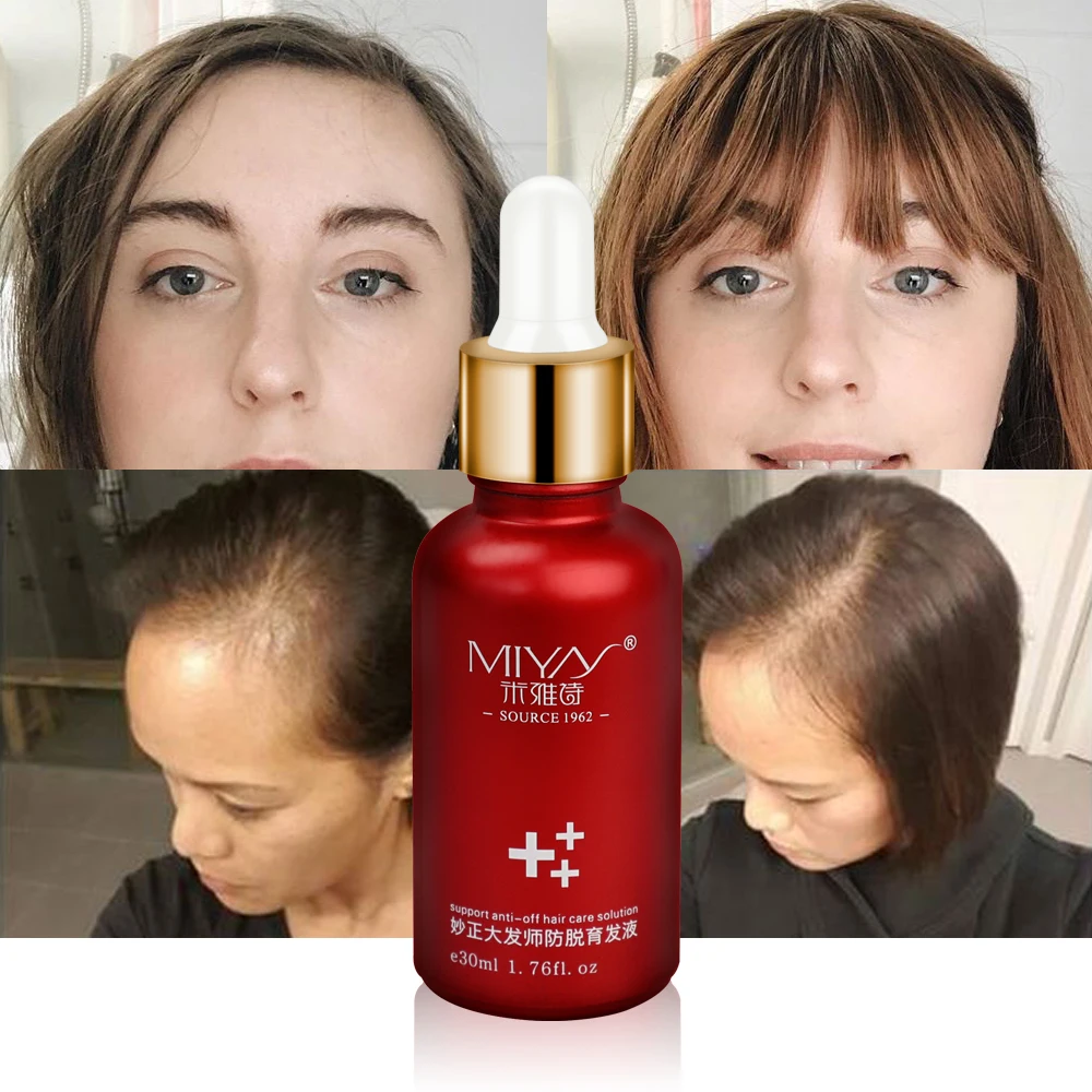 Hair Growth Essence Oil Anti Hair Loss Products for Hair Growth Treatment Genger Natural Serum Hair Thickener Care Solutions