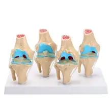 1 компл. Съемный скелет человека коленный сустав анатомия модель остеопороз патологический состояние модели медицинские Наука Обучающие принадлежности