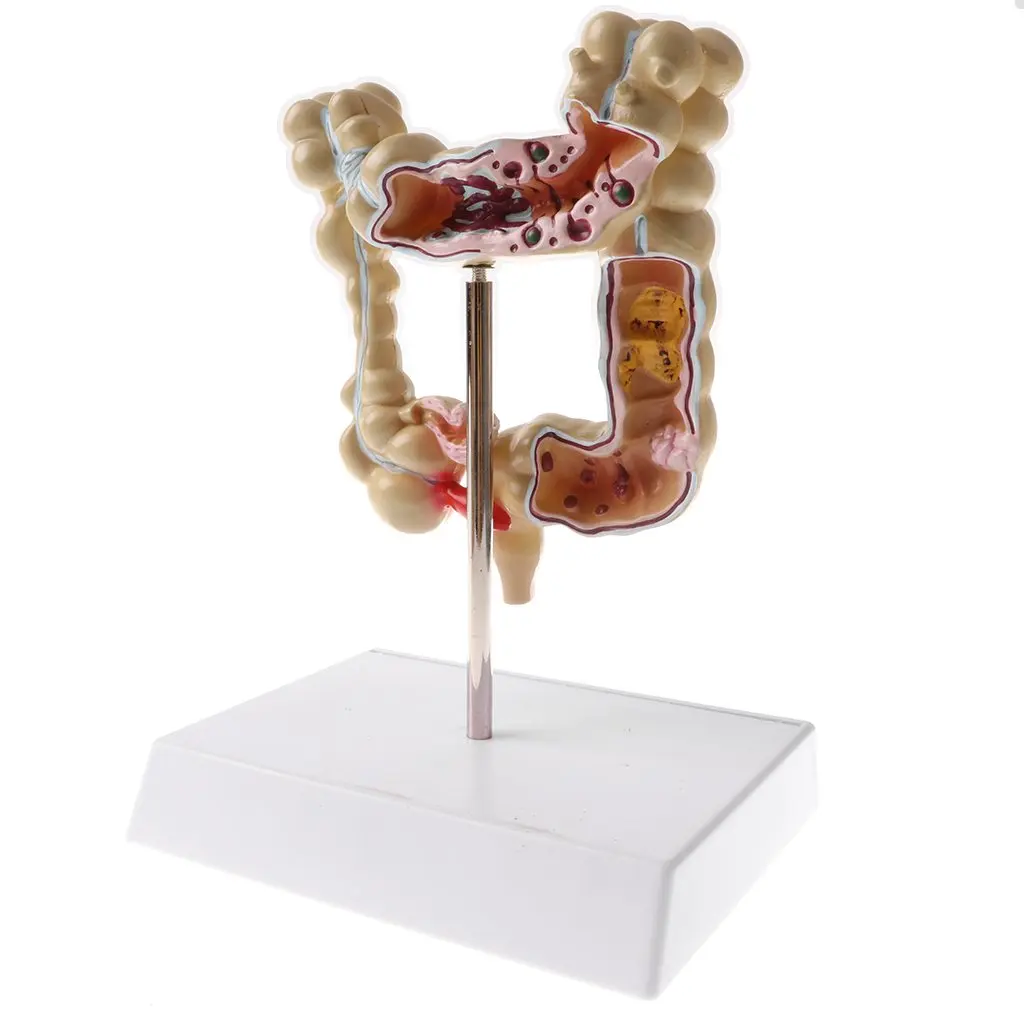  1: 2 Human Large Bowel Pathological Model Medical Anatomical Model for School Teaching Tool Learnin - 32973576715