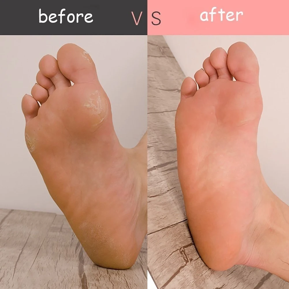 Cuidado de los pies Durable antideslizante extraíble hojas pie Rasp duro de la piel de la cabeza de removedor de callos pedicura raspador de cuidado de los pies herramienta