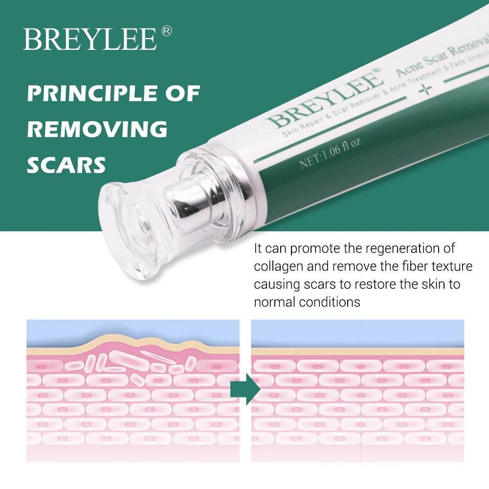 Breylee 3pcs Acne Scar Removal Cream Face Cream Skin Repair Skin Care Scar Acne Treatment Remove Stretch Marks Whitening Cream