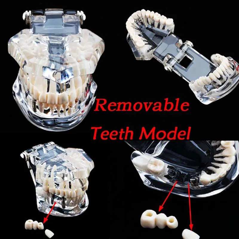 

Dental Implant Disease Removable Teeth Model Modeling With Restoration Bridge Tooth Dentist For Medical Science Teaching Study