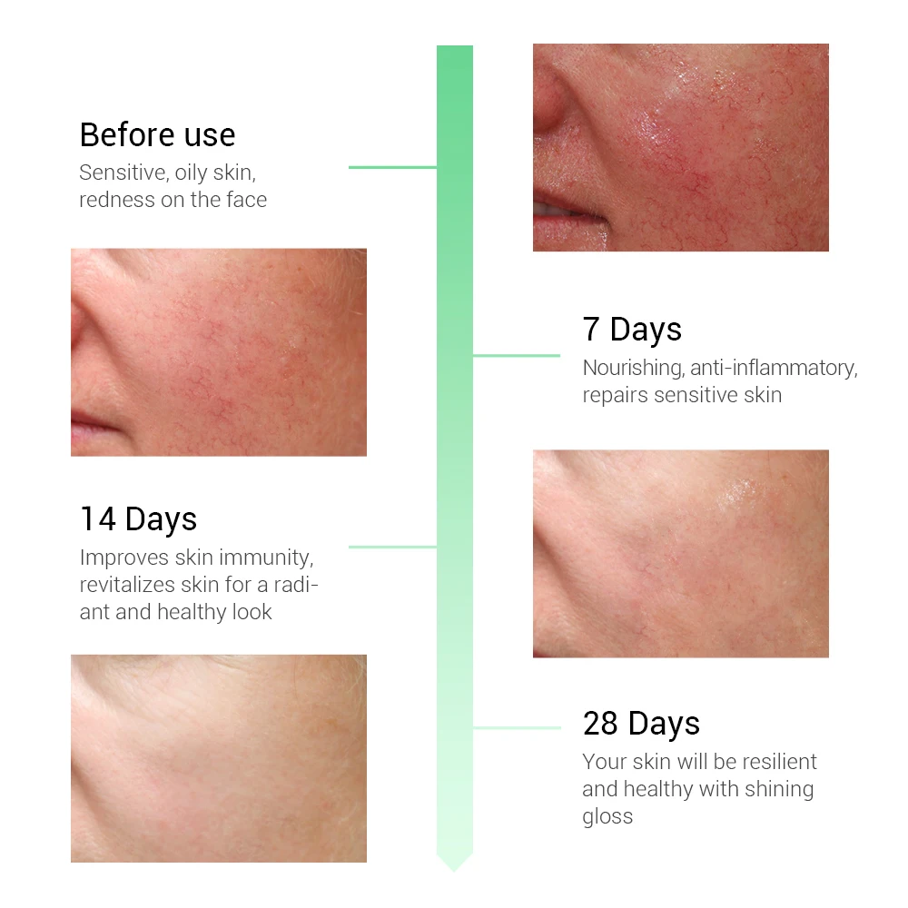 Breylee Repairing Serum Sensitive Skin Remove Fade Redness Treatment Soothing Whitening Face Skin Care Acne Scar Snail Serum
