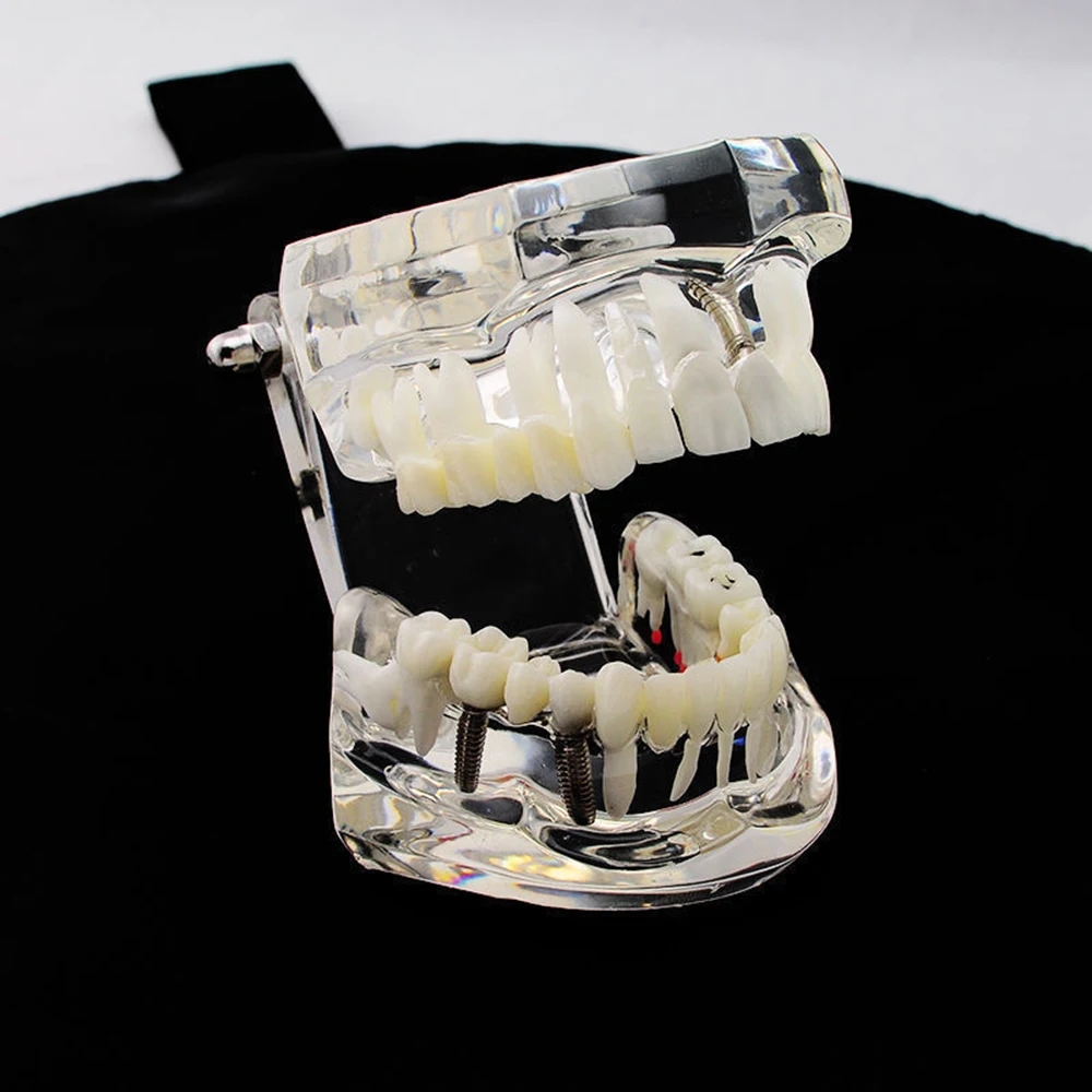  Dental Implant Disease Teeth Model With Restoration Bridge Tooth Dentist For Medical Science Dental - 33007186316