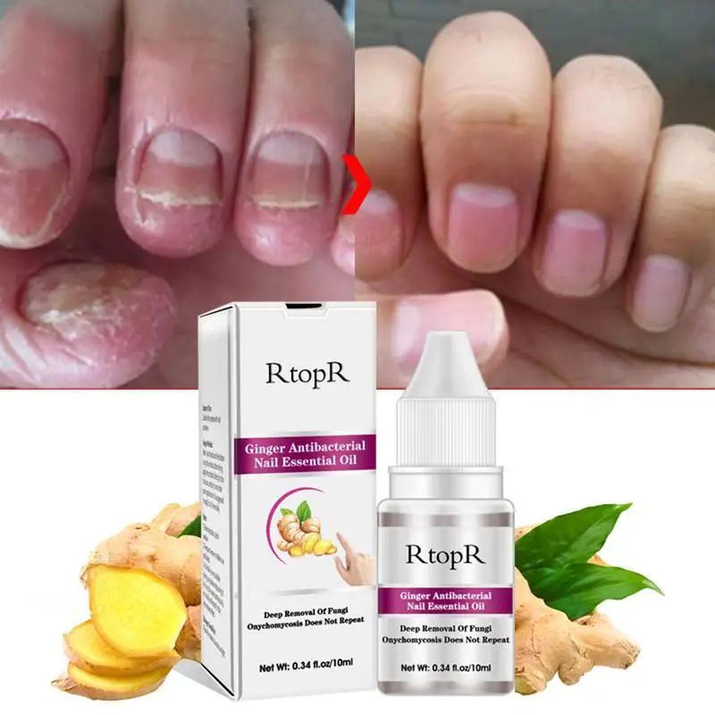 

Ginger Antibacterial Nail Treatment Onychomycosis Paronychia Anti Fungal Nail Infection Toe Nail Fungus Treatment Essential Oil4