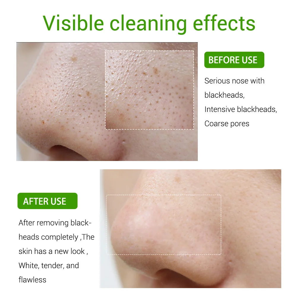 Lanbena Blackhead Removing Serum Deep Pore Acne Pimple Gentle Removal Acne Treatment Shrink Pores Purifying Skin Care 15ml