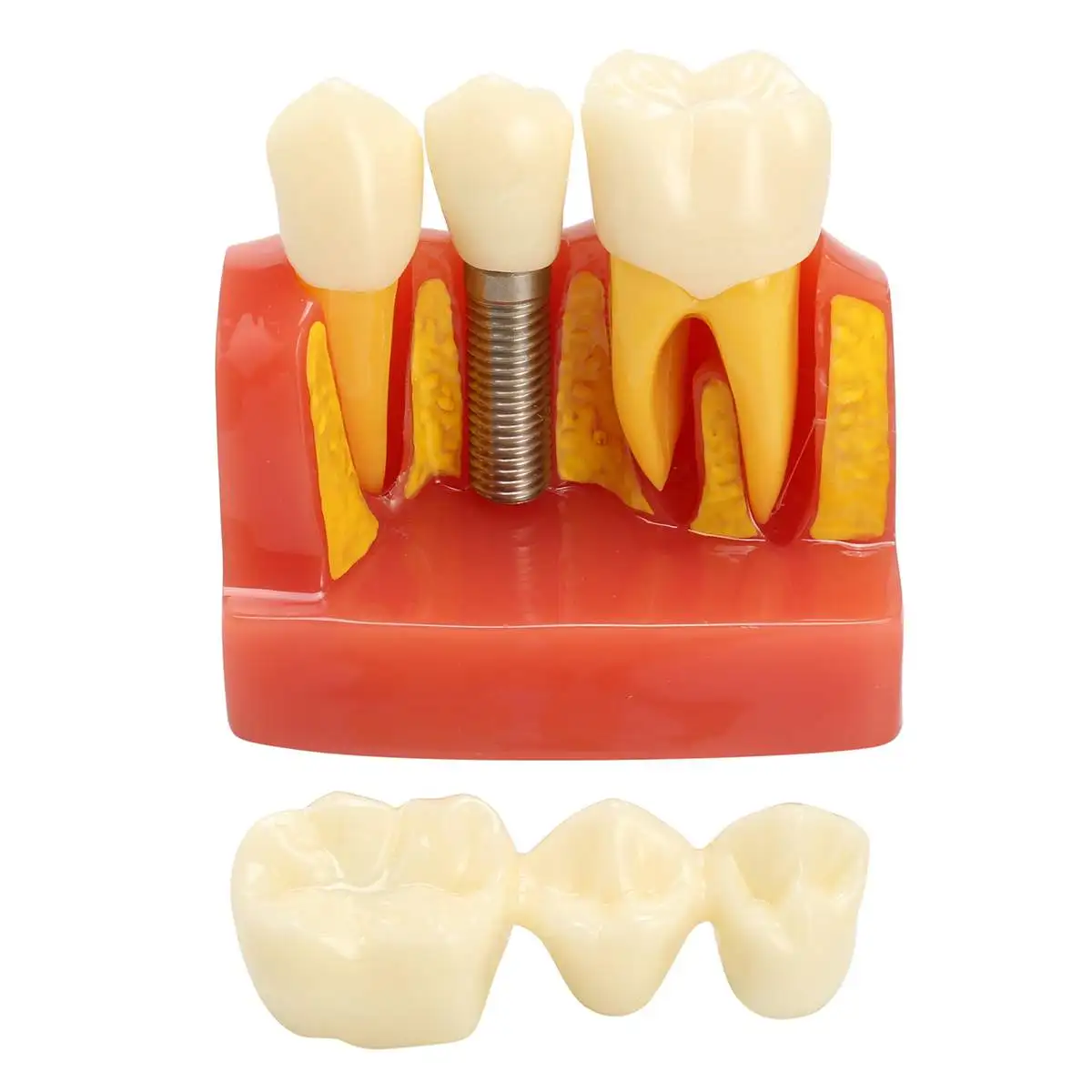 

Dental Teach Implant Analysis Crown Bridge Removable Model Dental Demonstration Teeth Mould for Medical Teaching Study Dentist