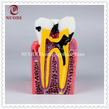 

Dentist Communication Caries teeth Model/6Ttimes Caries Comparation tooth model/Dental Caries Leaning teeth model
