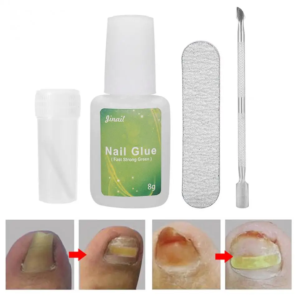 

5Pcs/set Ingrown Toenail Correction Tool Paronychia Recover Toe Nail Fixer Corrector with Toenail Patch Nail Glue Pedicure Tools