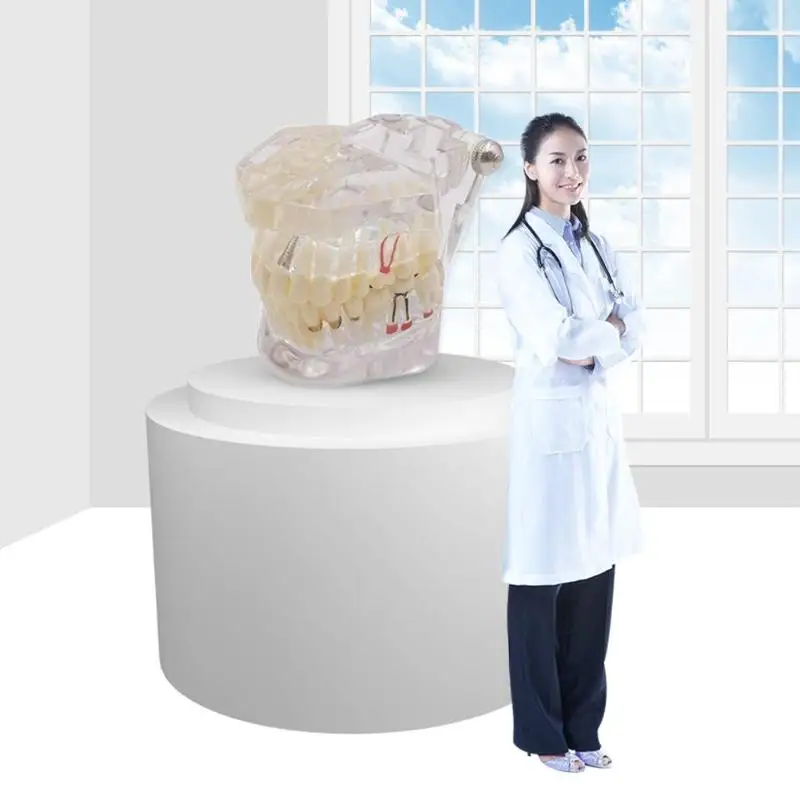 1pcs Dental Implant Disease Teeth Model With Restoration Bridge Tooth Dentist For Medical Science Dental Disease 3