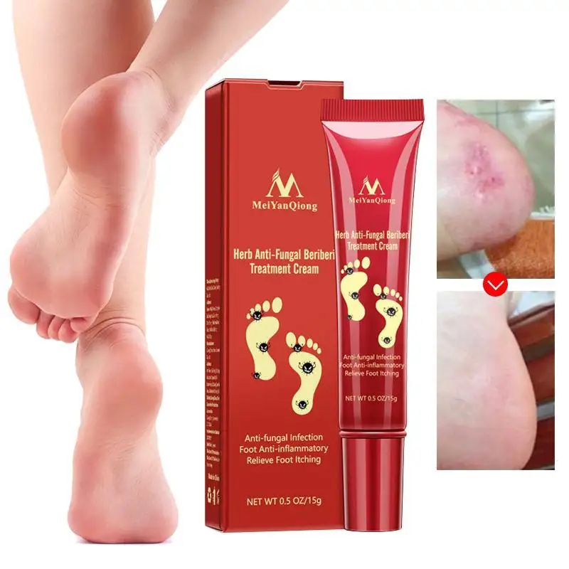 Анти грибковые Foot Treatment Cream китайских травяные ногтей Удаление грибка ноги