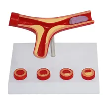 Атеросклероз модель структура человеческого сосуда медицинский анатомический модель для школы преподавания инструмента обучения дисплей