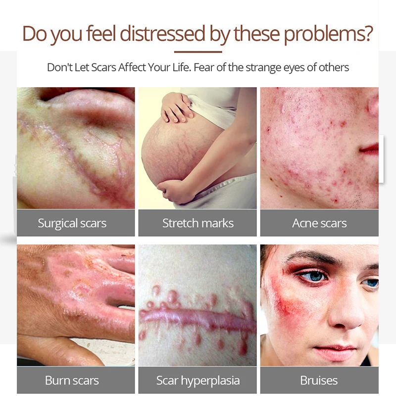 VIBRANT GLAMOUR Acne Treatment Cream Repair Face Marks Remove Acne Scar Crocodile Whitening For Spots Acne Treatment Stretch VIBRANT GLAMOUR Acne Treatment Cream Repair Face Marks Remove Acne Scar Crocodile Whitening For Spots Acne Treatment Stretch