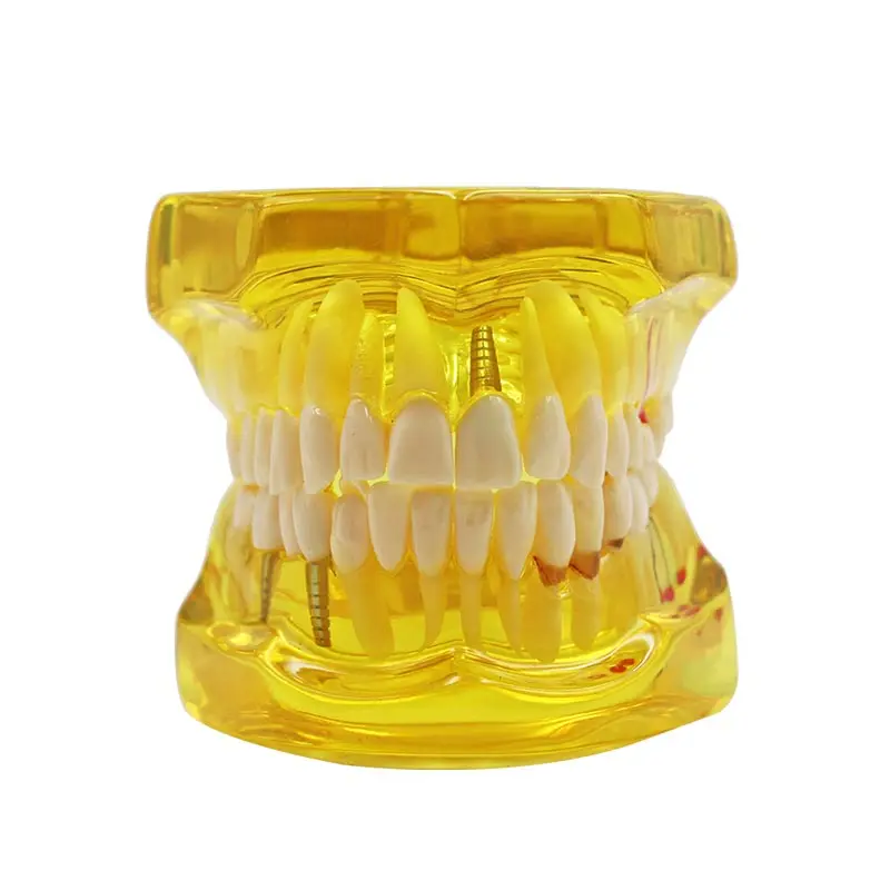 1 шт. Стоматологическая модель зубов, обучающая модель зубных зубов, модель имплантации зубов, Съемные Инструменты для обучения, оборудование