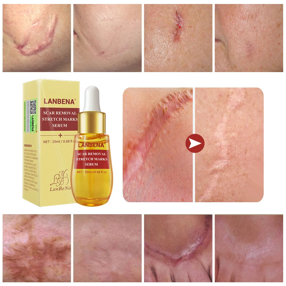 LANBENA Acne Scar Remove Serum Acne Treatment Remover Stretch Marks