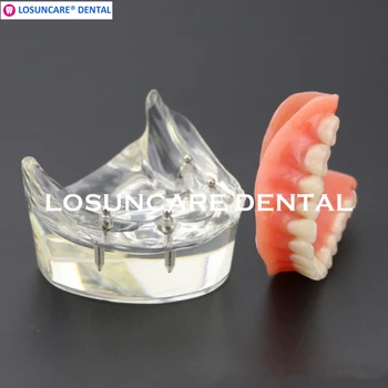 

LOSUNCARE 5pcs Dental Teeth Study Overdenture Inferior 4 Implant Demo Teaching Model for dentist