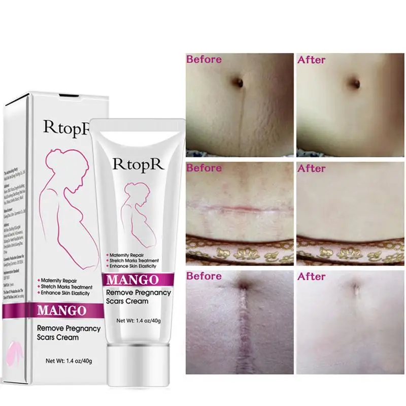 

40G Mango Remove Pregnancy Scars Acne Cream Stretch Marks Treatment Maternity Repair Anti-Aging Anti Winkles Firming Body Creams