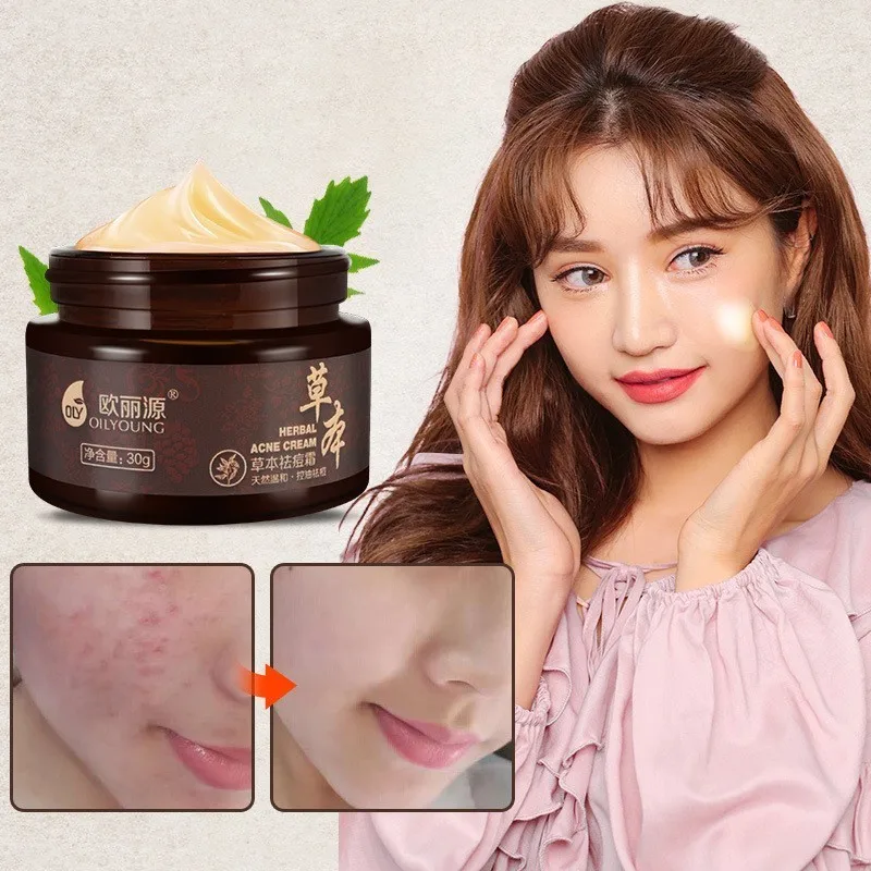 Herbal Acne Cream 30g Anti Pimple Spot Scars Blackhead Removal Whitening Skin Face Care Treatment DropShip|Автозагары и