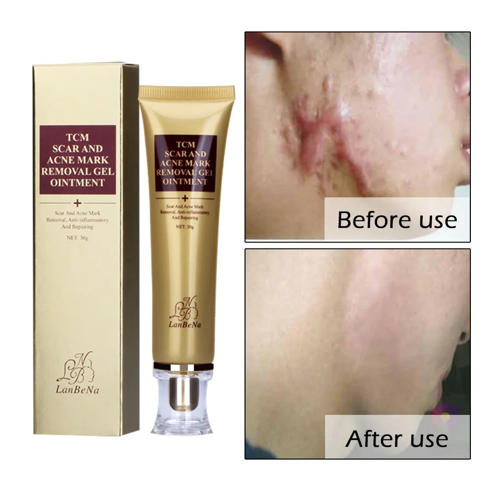 LANBENA Acne Scar Removal Cream Face Cream Skin Repair Spots Acne Treatment Blackhead Whitening Cream Stretch Marks Skin Care