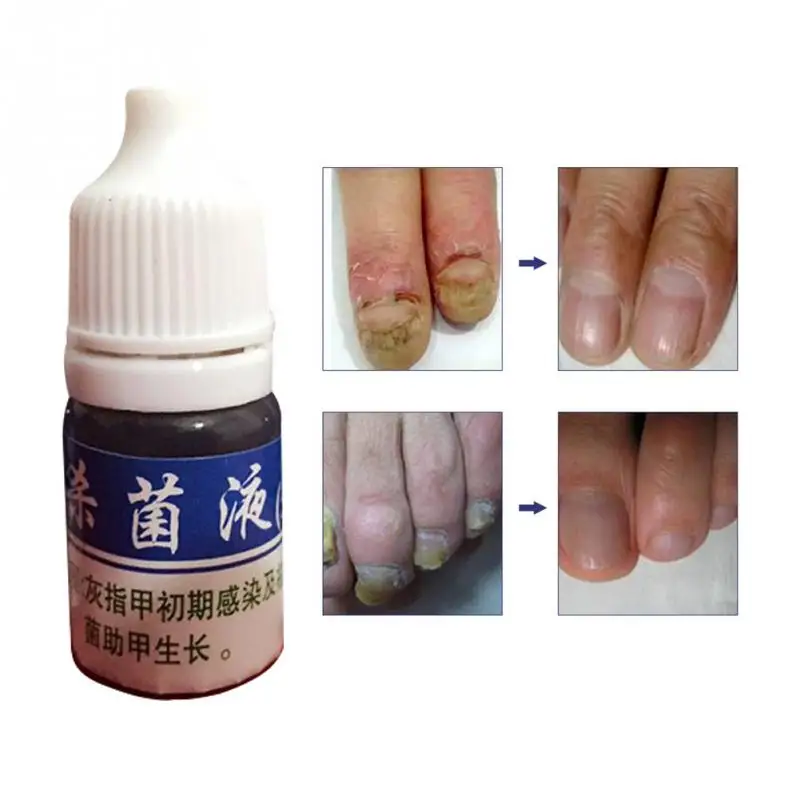 10 мл Высокое качество ремонт ногтей Onychomycosis Remover грибок грибковая Жидкость против