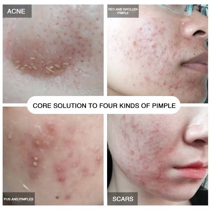 anti pimple face cream