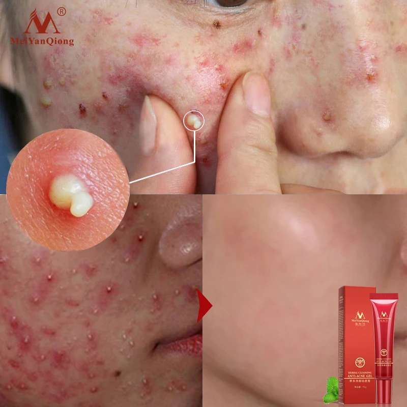 Herbal Face Anti acne Remove Repair treatment cream Herbal scar removal Quickly oily skin Quickly Acne 1 Herbal Face Anti acne Remove Repair treatment cream Herbal scar removal Quickly oily skin Quickly Acne 5