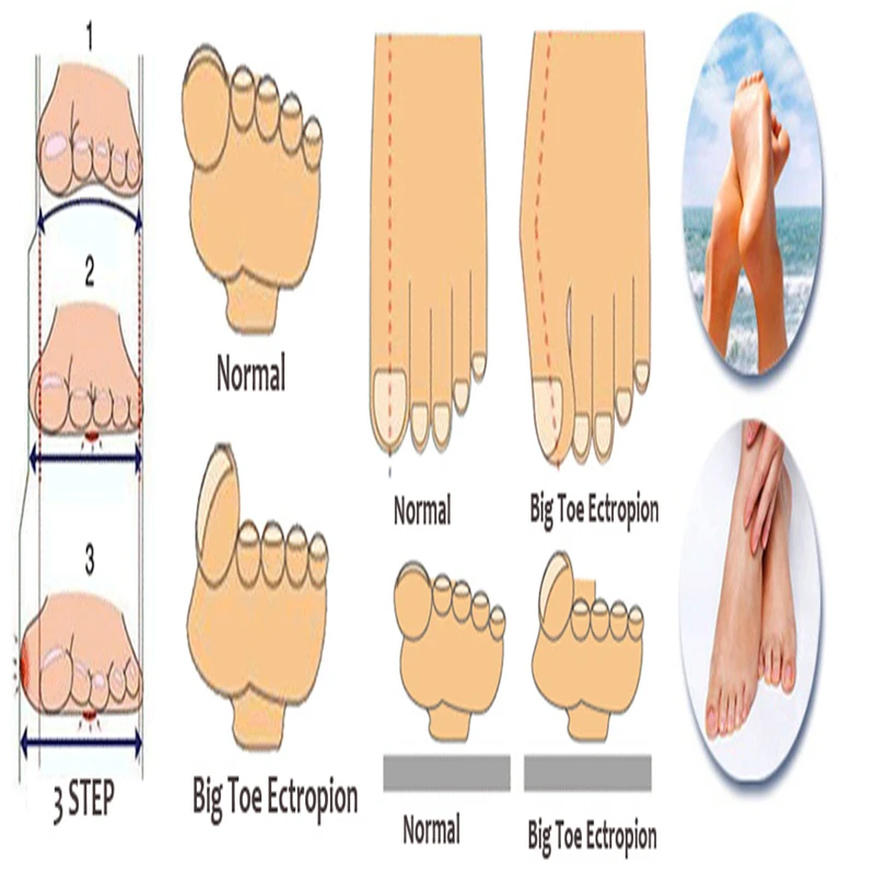 2017 Hot Sell Silica Gel Bunion Corrector Beetle-crusher Ectropion Toe Separator Straightener For Women Gift 2017 Hot Sell Silica Gel Bunion Corrector Beetle-crusher Ectropion Toe Separator Straightener For Women Gift