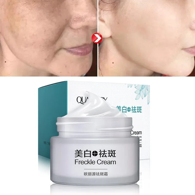 

QUARXERY Whitening Cream Face Anti Freckle Cream Moisturizing Anti Pigmentation Reduce Age Spots Fade Dark Spot Korean Cosmetics