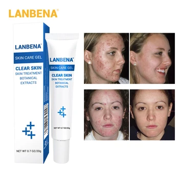 

LANBENA Removing Scar Ointment Skin Care Gel Acne Removal Controller Face Acne Cream Scar Removing Skin Care Gel Product