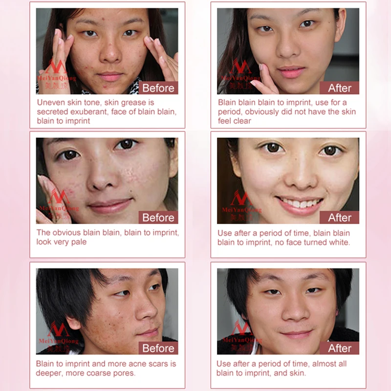 Herbal Face Anti acne Remove Repair treatment cream Herbal scar removal Quickly oily skin Quickly Acne 1 Herbal Face Anti acne Remove Repair treatment cream Herbal scar removal Quickly oily skin Quickly Acne 4