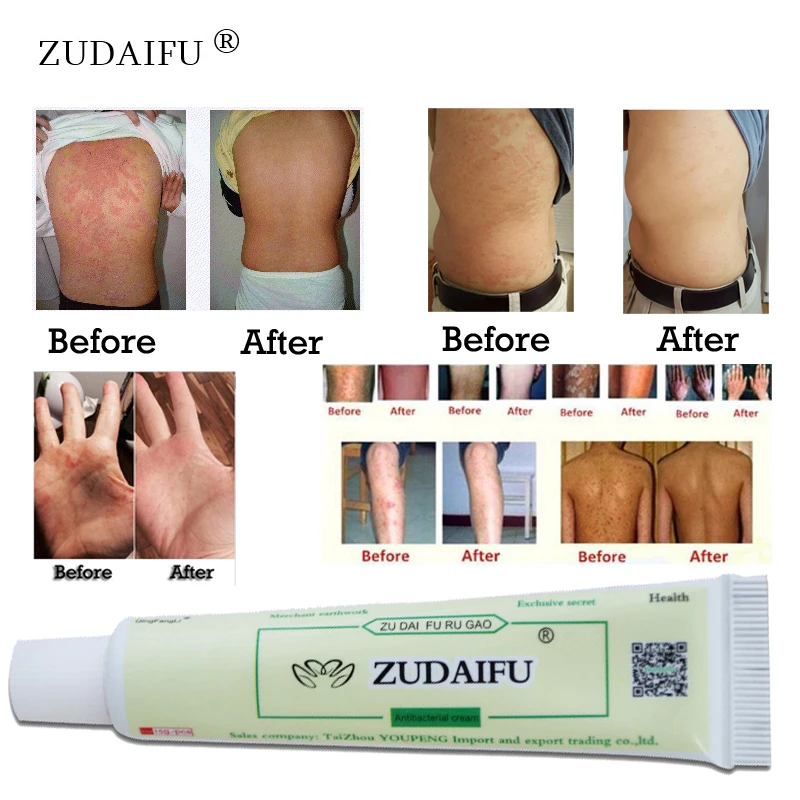 ZUDAIFU продукт по уходу за кожей снимает псориаз дерматит эффект призмы без