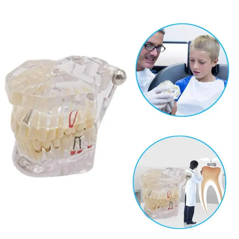 1pcs Dental Implant Disease Teeth Model With Restoration Bridge Tooth Dentist For Medical Science Dental Disease 4