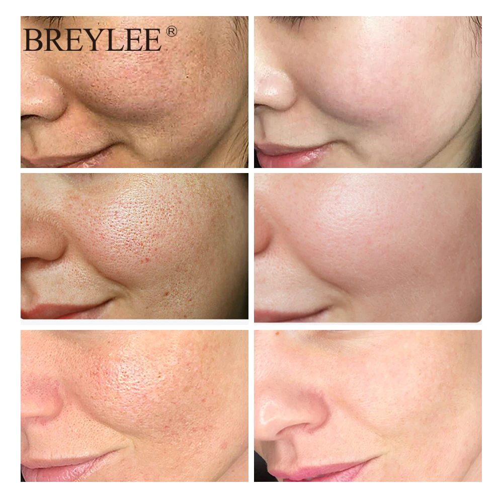 Breylee Hyaluronic Acid Serum Moisturizing Facial Essence Face Skin Care Nourishing Repairing Whitening Cream Ageless Beauty Breylee Hyaluronic Acid Serum Moisturizing Facial Essence Face Skin Care Nourishing Repairing Whitening Cream Ageless Beauty