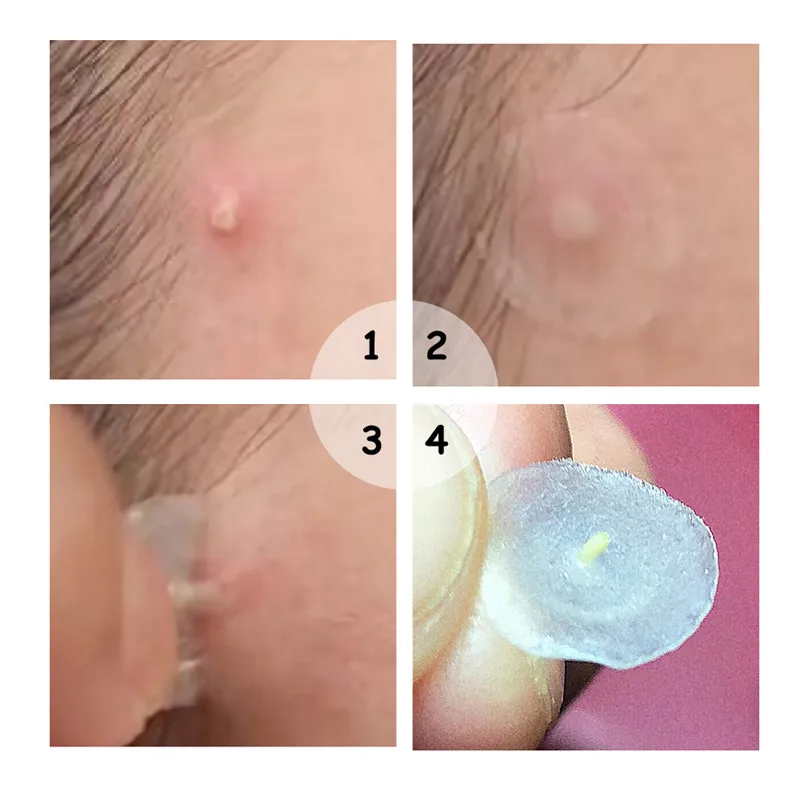 22pcs/bag Face Spot Scar Care Acne Pimple Master Patches Treatment Stickers Anti Infection Pimple Spot Face Care Tools 22pcs/bag Face Spot Scar Care Acne Pimple Master Patches Treatment Stickers Anti Infection Pimple Spot Face Care Tools