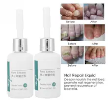 Восстанавливающая жидкость для ногтей Лечение грибка Onychomycosis Уход за ногтями жидкий маникюрный набор инфекция ногтей ногти Уход за ногтями 20 мл