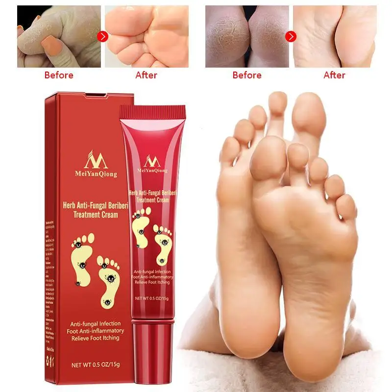 Natural Herbal Effective Toe Fungus Treatment Chinese Medicine Fungal
