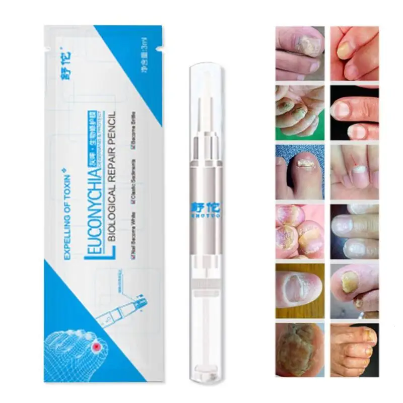 Nail Fungus Treatment Chinese Medicine Herbs Powerful for Toe Nail