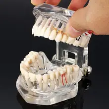 Горячая зубной имплантат, зубная модель с реставрационным мостом, зубной Стоматолог для медицинских исследований