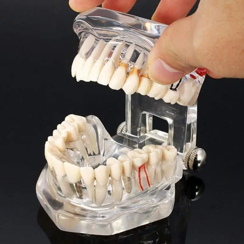 1pcs Dental Implant Disease Teeth Model With Restoration Bridge Tooth Dentist For Medical Science Dental Disease 2