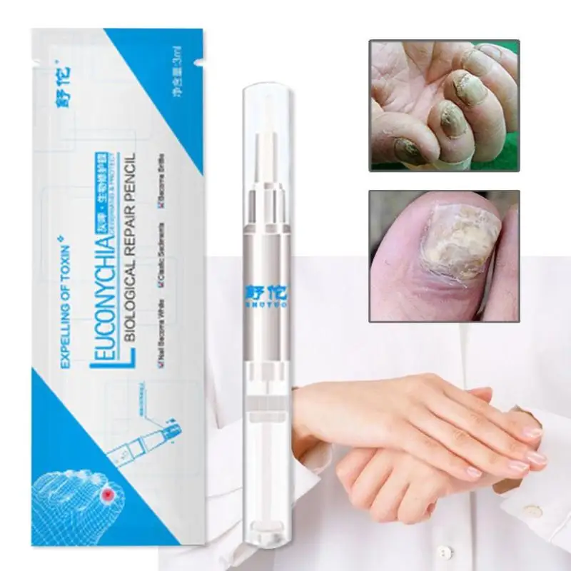 

Nail Fungus Treatment Ointment Treatment Toe Nail Onychomycosis Paronychia Anti Fungal Nail Infection U3