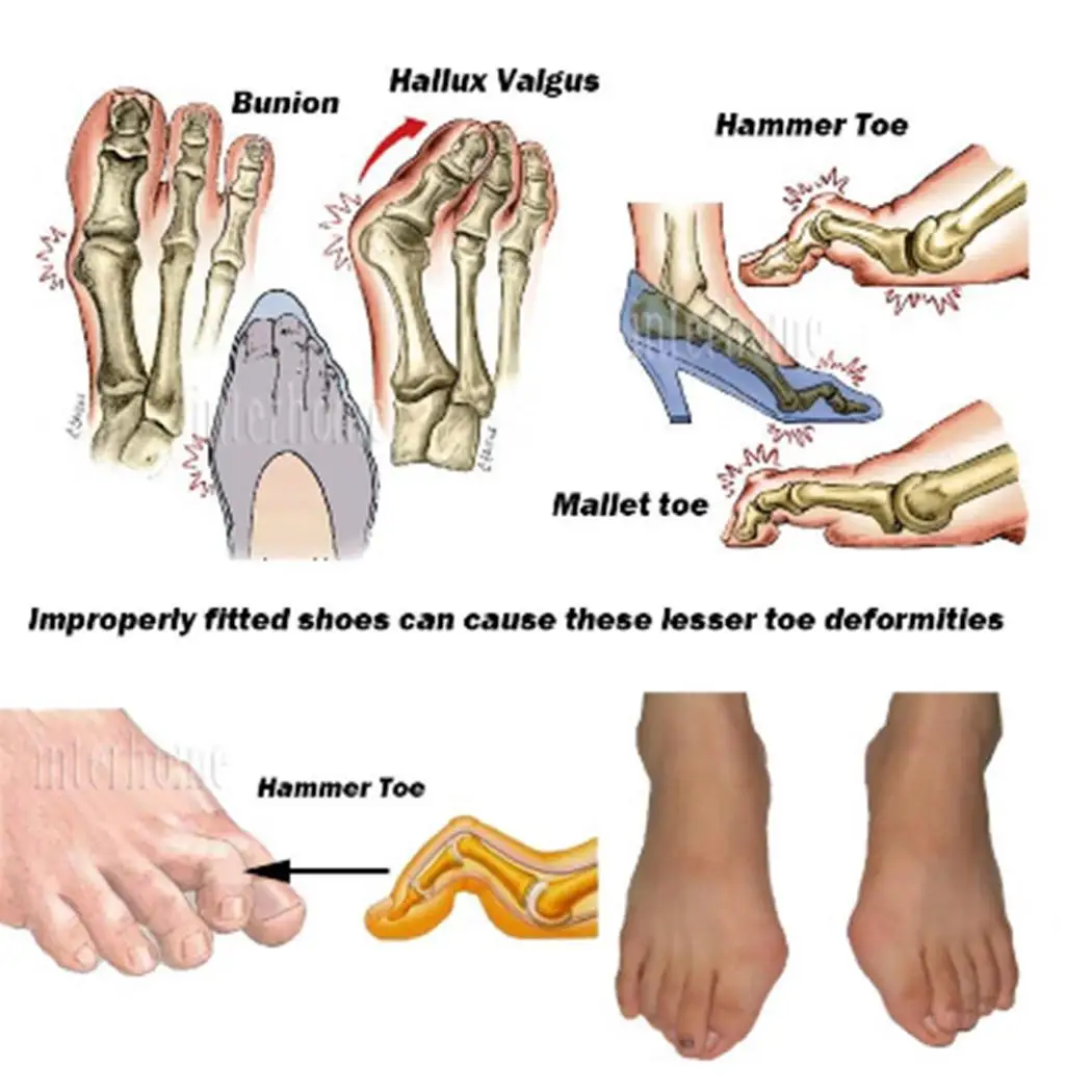 Кости мизинца стопы. Кости мизинца стопы. Кости мизинца стопы. Проксимальная фаланга 1 пальца стопы. Анатомия большого пальца ноги.