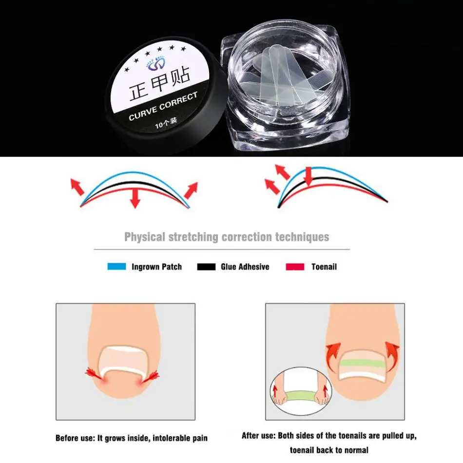 10 шт./кор. ногти для ног "францзуский маникюр" коррекции вросших Стикеры патч носок фиксатор для ногтя восстановить педикюр инструменты аксессуары