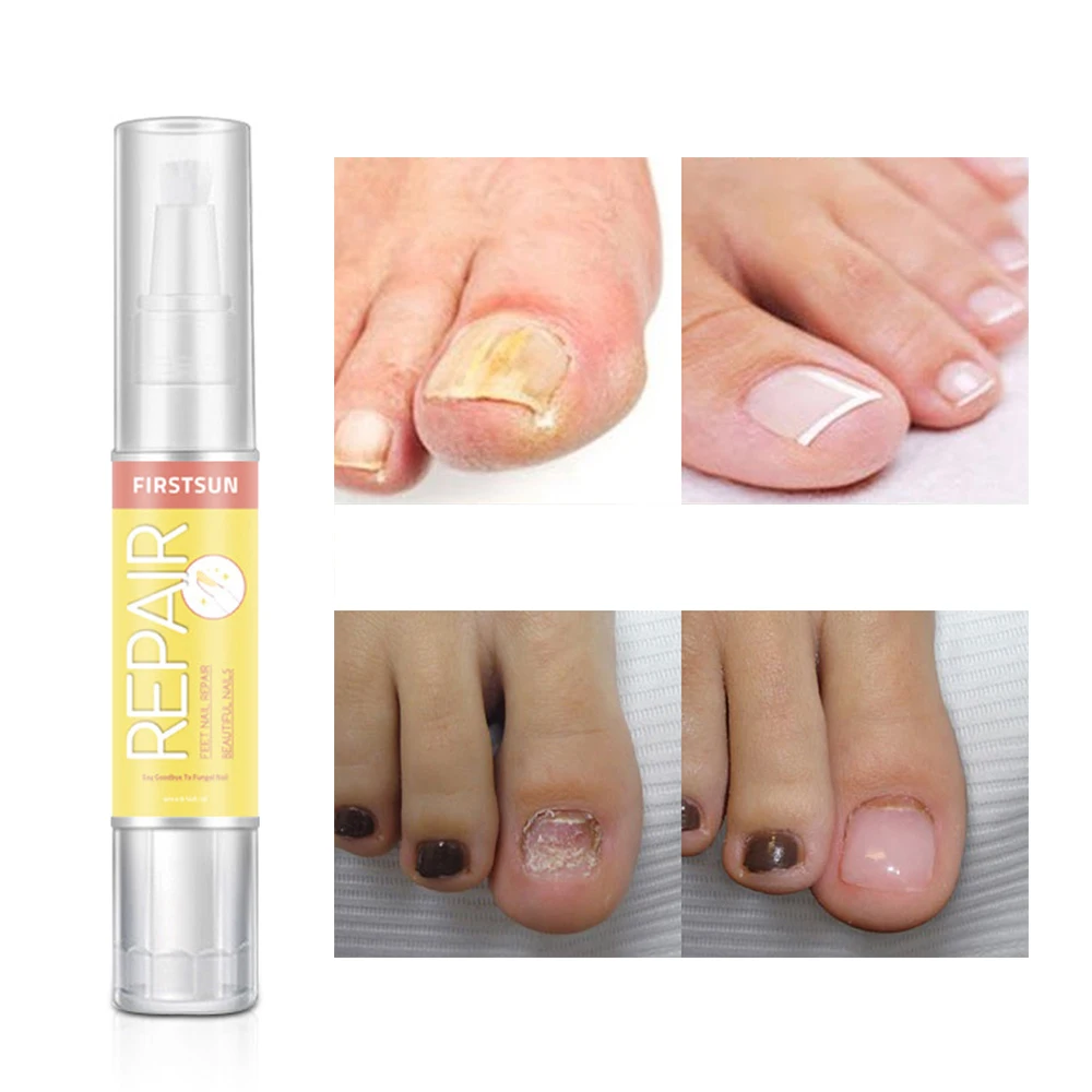 

4 ML Fungal Nail Treatment Essence Liquid Whitening Toe Nail Fungus Removal Nail Art Tool Foot Nail/Feet Care Makeup