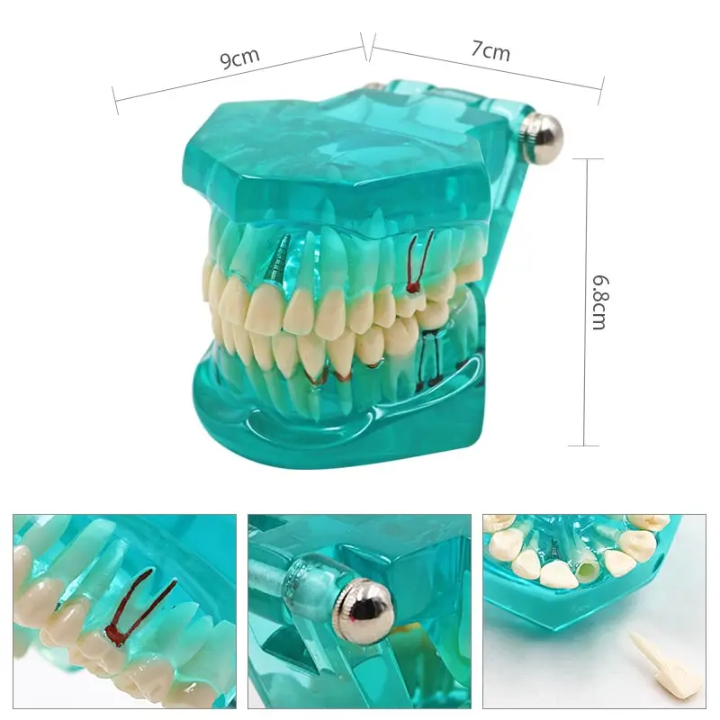 Устные зубы преподавания модели стоматологических зубы болезни модель имплантации стоматологические инструменты Зуб модель Съемная Training инструменты оборудование