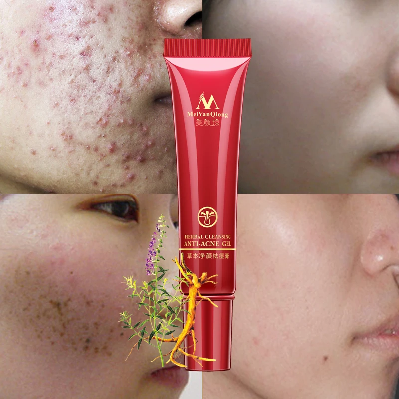 

Herbal Face Anti acne Remove Repair treatment cream Herbal scar removal Quickly oily skin Quickly Acne Spots skin care face