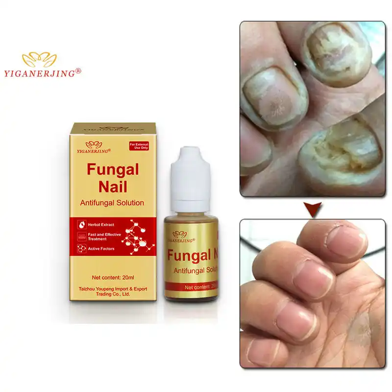 ROSALIND Nail Fungus oil Onychomycosis Treatment Repair To Nail Polish