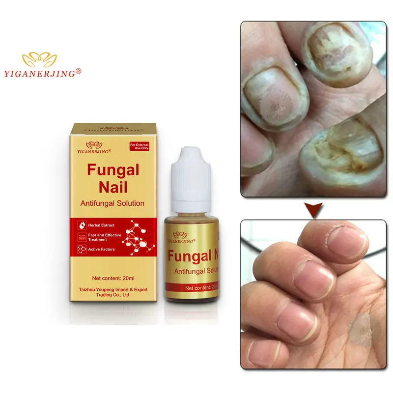 

Fungal Nail Treatment Feet Care Essence Nail Foot Whitening Toe Nail Fungus Removal Gel Anti Infection Paronychia Onychomycosis